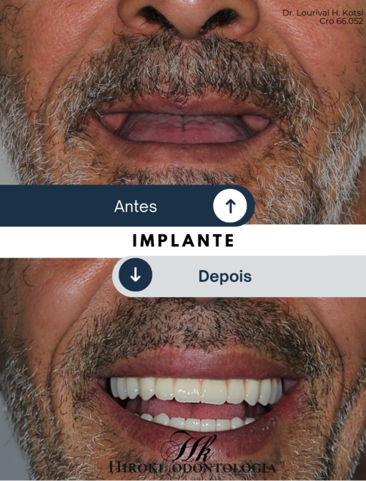 C-pia-de-Antes-e-Depois---Stories-Post-para-Instagram-45-.png